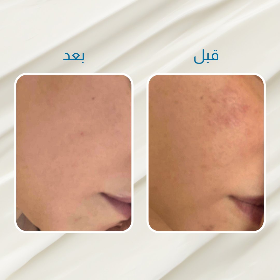 الكورس الاقوى لعلاج الحبوب باربي فار –1